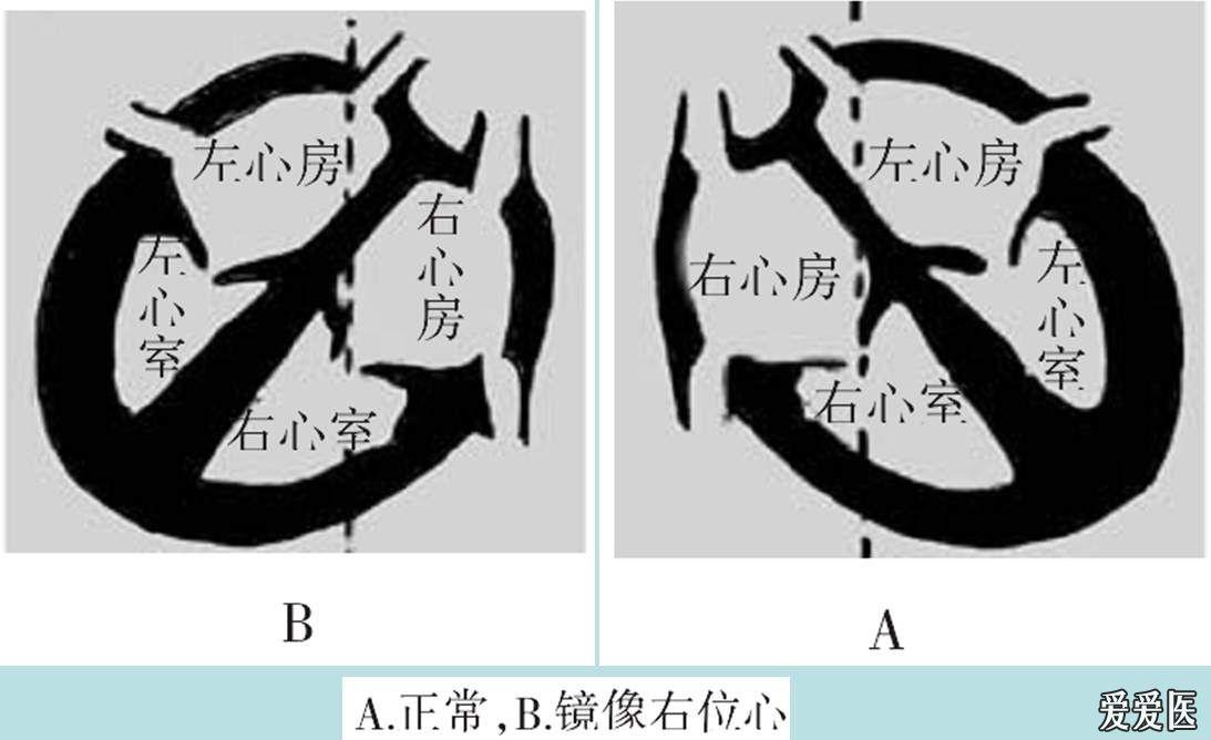 看图学心电01左右手反接与镜像右位心