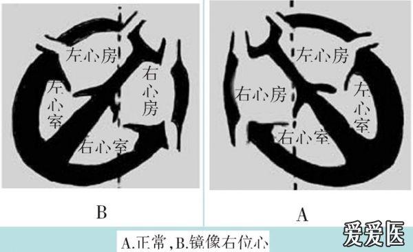 看图学心电01左右手反接与镜像右位心