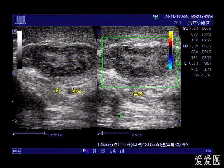 十万火急病例请你会诊(随访结果在27楼-多睾症 超声医学讨论版-