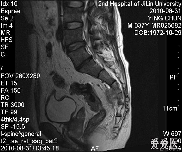 左侧骶骨占位性病变讨论(dr ct mri)