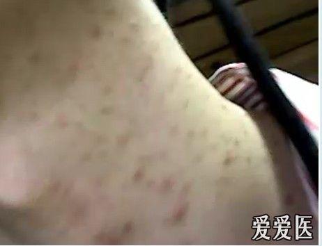 帮我看看长在脖子上的疹子是什么?毛囊炎?