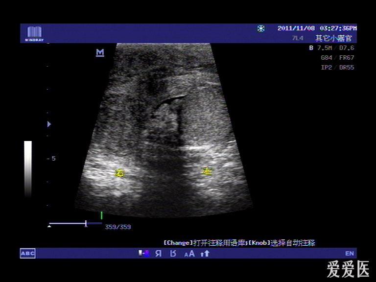 十万火急病例请你会诊(随访结果在27楼-多睾症 超声医学讨论版-