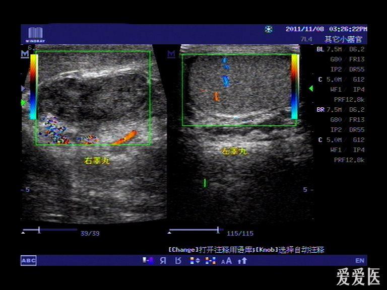 下午3点半来诊,右侧阴囊明显肿胀,皮肤黑色,行超声检查如图,cdfi右侧