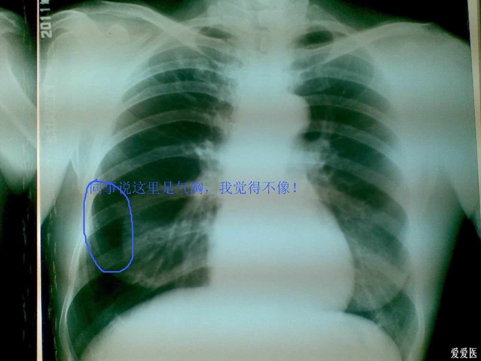 初步诊断:肺气肿.