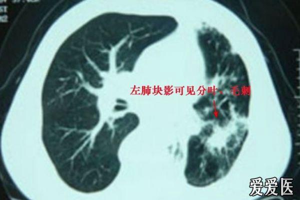 结合病史考虑左下叶支气管结石,左下肺不张毁损,左肺癌待排除,建议经