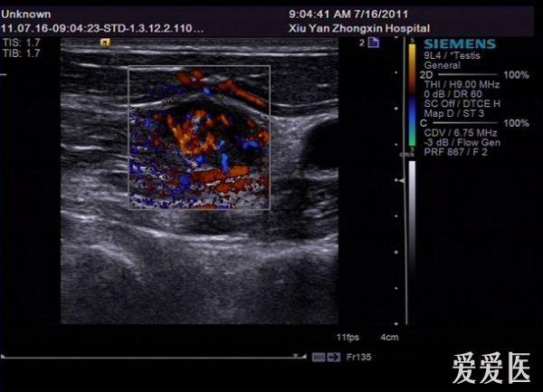 做甲状腺超声时 发现的食道癌 - 超声医学讨论版 - 爱爱医医学论坛