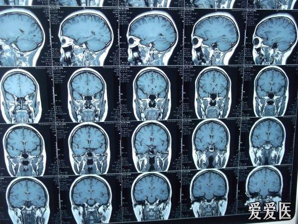 脑垂体瘤术后33个月复查,复发?