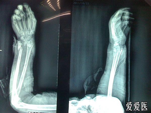 x线:左桡骨远端骨折骨折端向背侧移位,尺骨远端向尺掌侧移位.
