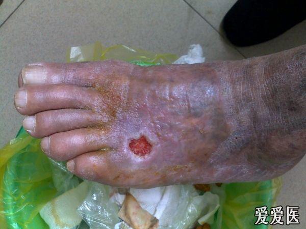 请帮我看看我的病人的下肢脚背皮肤溃烂的处理方法!