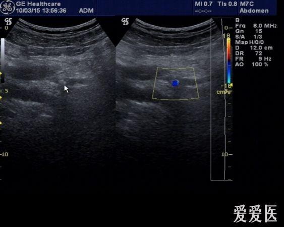 泌尿系统各种部位结石