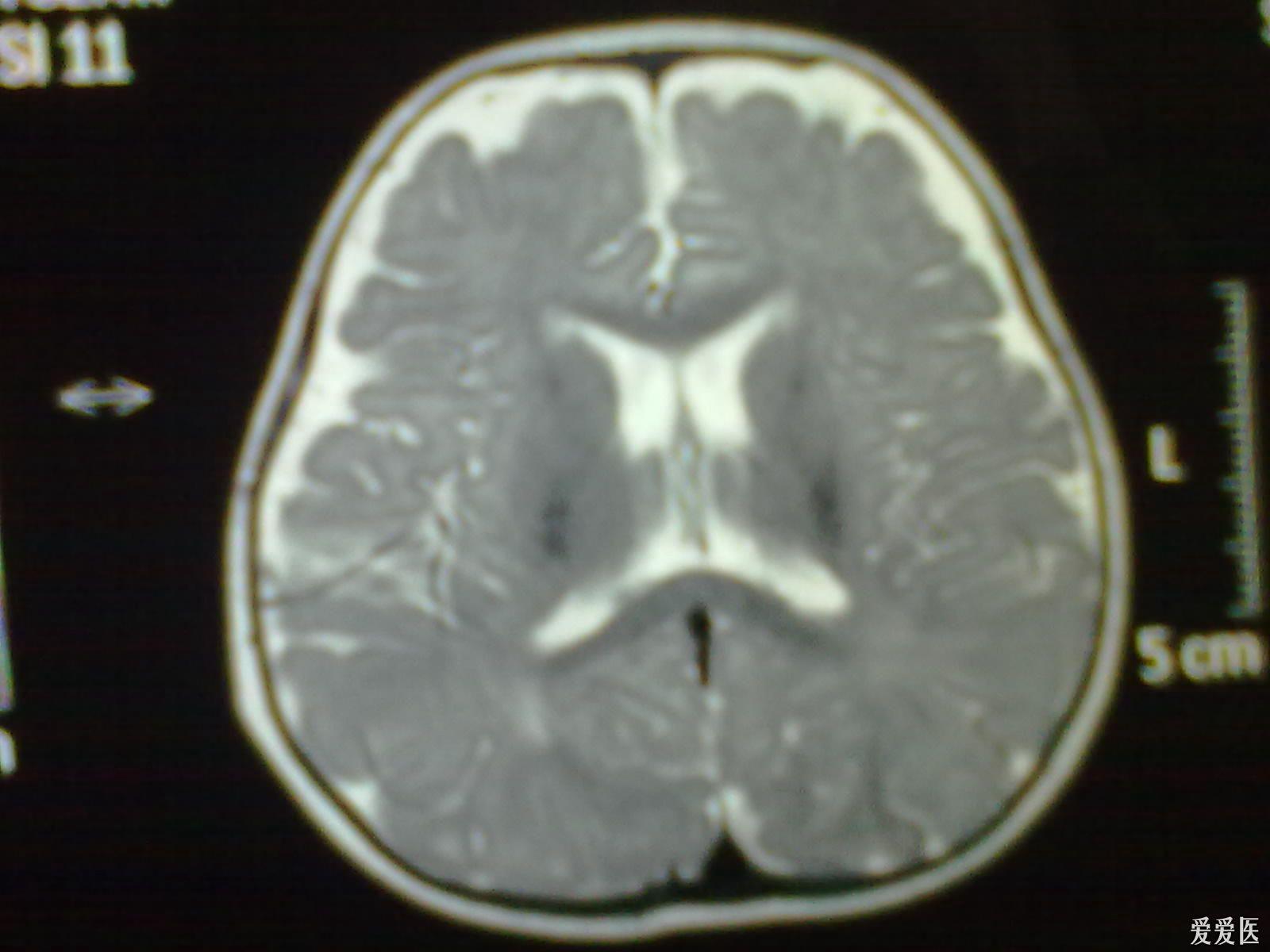 求教右侧脑室体后部脑白质可见片状稍高信号