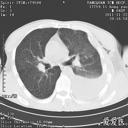 矽肺还是粟粒性肺结核?