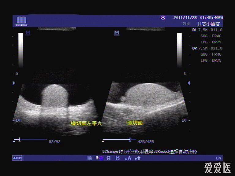 超大睾丸鞘膜积液(体表图超声图比对)