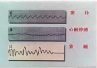 【专题讲座】室颤