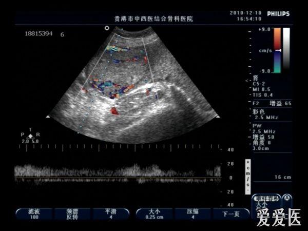 胎盘植入 - 超声医学讨论版 - 爱爱医医学论坛-爱爱医