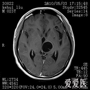 脑囊虫,怎么诊断