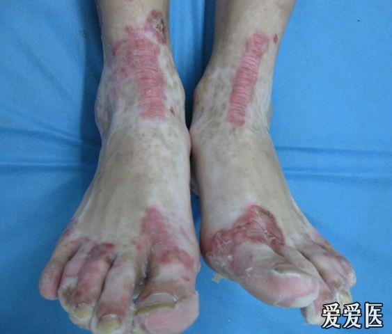 典型病例展示11—肠病性肢端皮炎