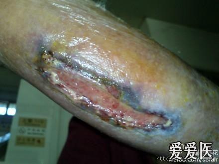 102岁老人压疮(?)治疗求助