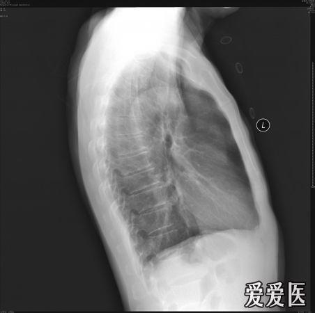 胸部正侧位.