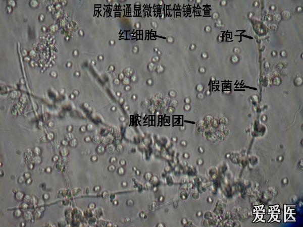 尿沉渣相差显微镜 - 检验医学讨论版 - 爱爱医医学