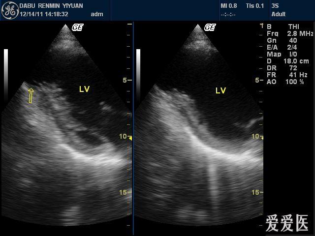 左心室壁瘤 超声医学讨论版 爱爱医医学论坛 爱爱医医学网