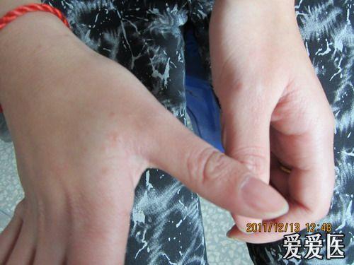 看图诊断—30 疥疮(答案见38楼)