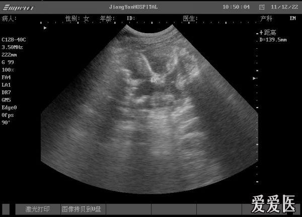 左肾皮质内一些高回声团块