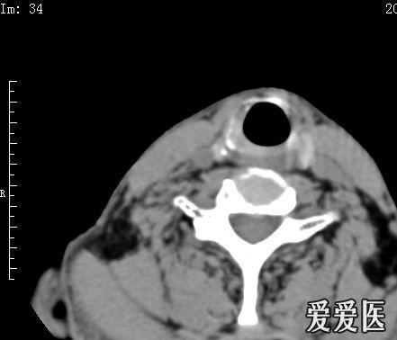 左侧杓会厌皱襞增厚,左侧梨状窝变小,有什么样的意义呢?