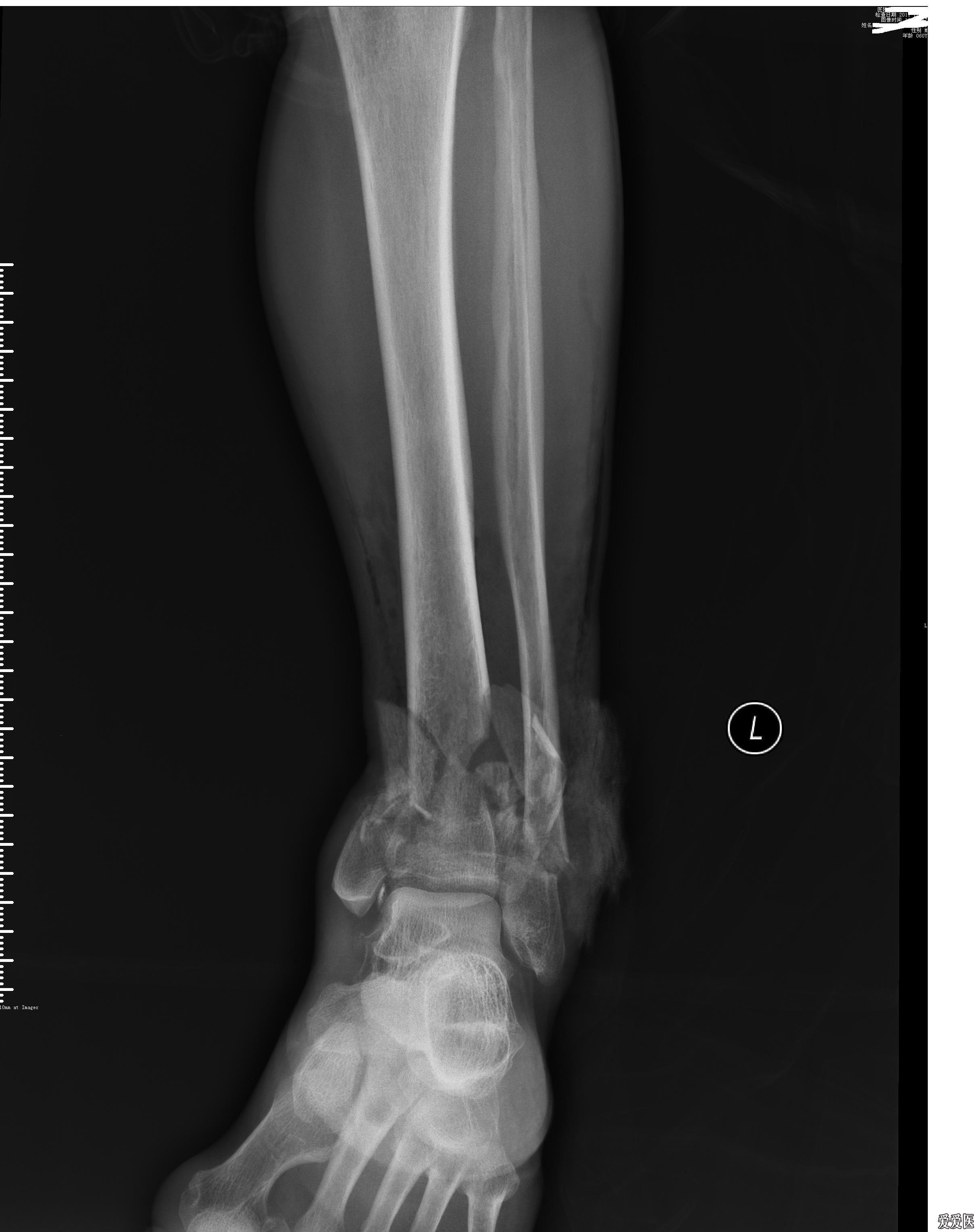 左脚第五趾骨基底部骨折。 - 知乎