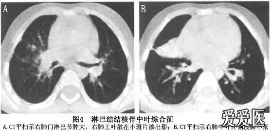 原发型肺结核