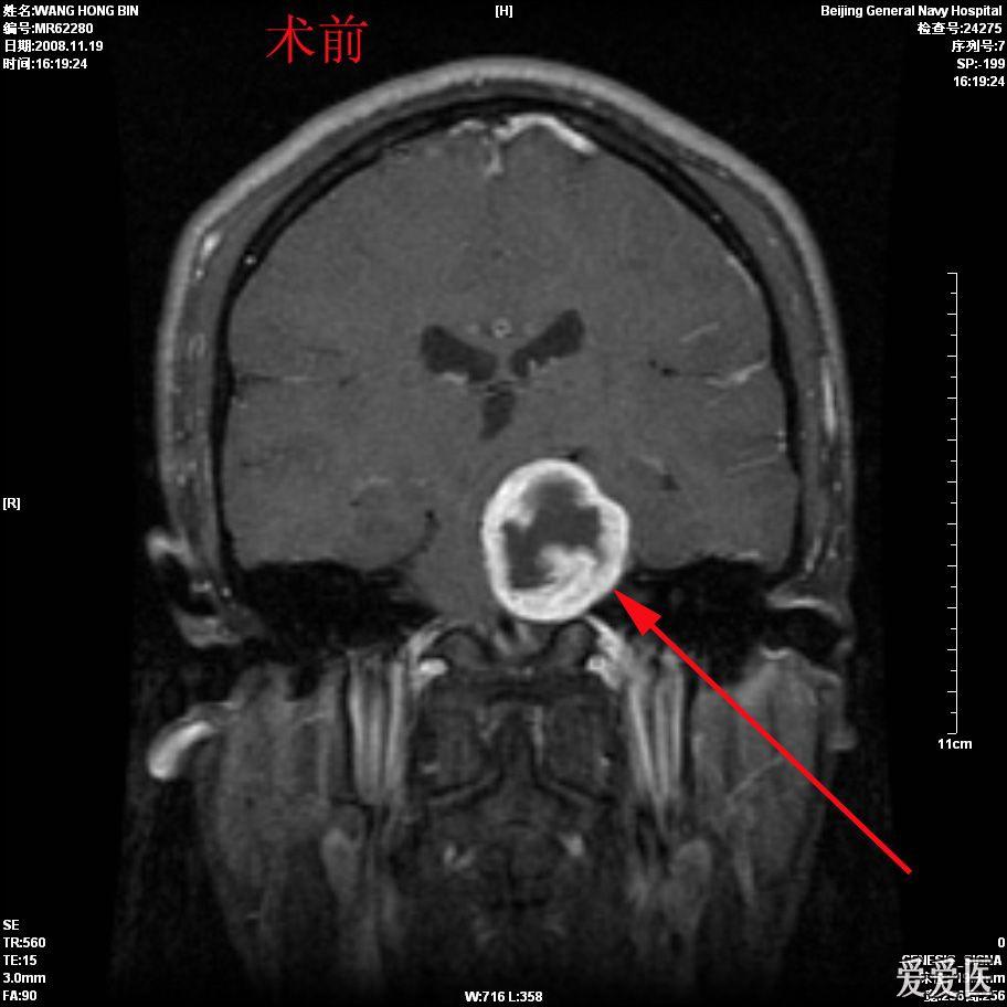 病理为三叉神经鞘瘤.术后出现轻度外展神经麻痹,渐恢复.