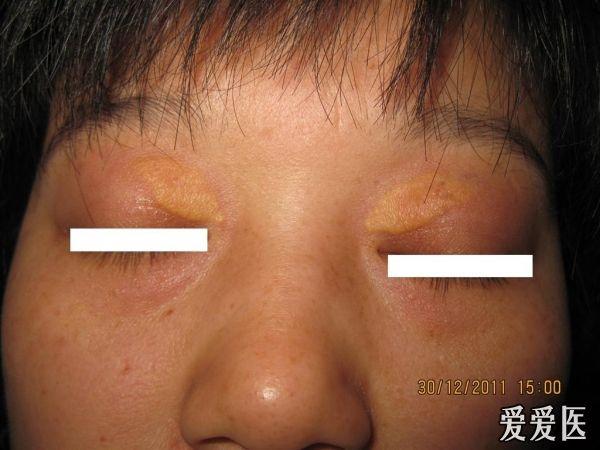 典型病例--------典型的睑黄瘤
