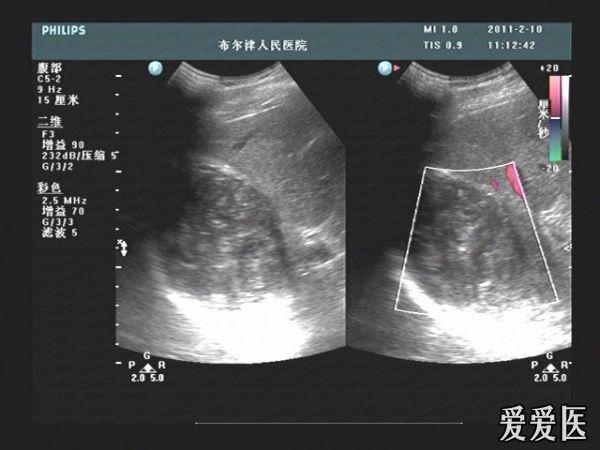 肝包虫大全 - 超声医学讨论版 - 爱爱医医学论坛-爱爱