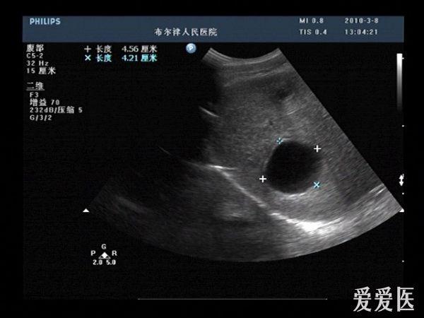 肝包虫大全 - 超声医学讨论版 - 爱爱医医学论坛-爱爱