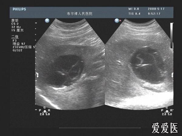 肝包虫大全 - 超声医学讨论版 - 爱爱医医学论坛-爱爱