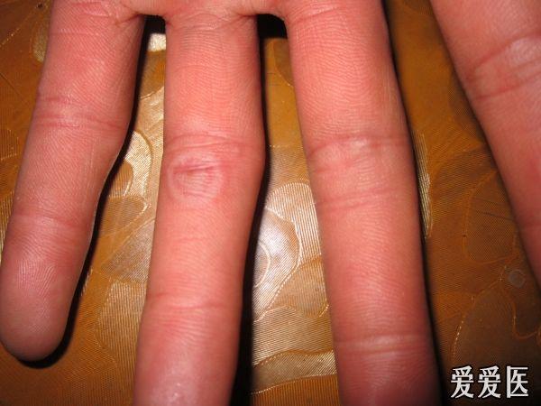 寒冷性多形红斑