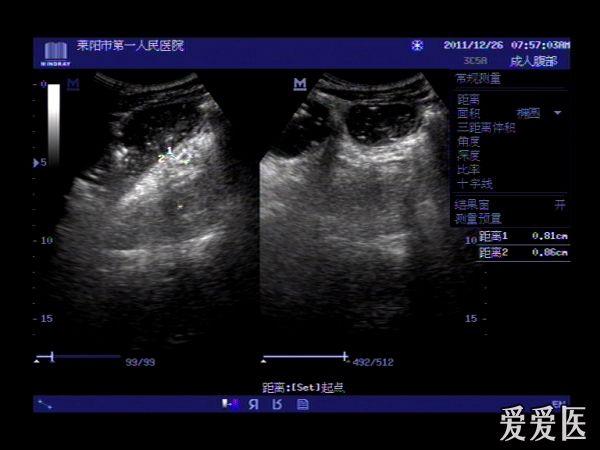 小肠梗阻 - 超声医学讨论版 - 爱爱医医学论坛 - 爱爱