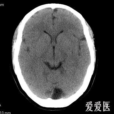 枕大池能诊断囊肿吗?