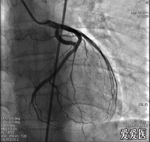 冠脉造影-心肌桥诊断(有图片)