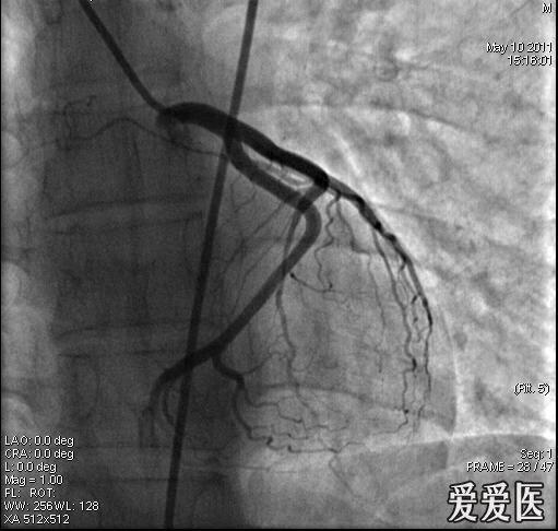 冠脉造影-心肌桥诊断(有图片)