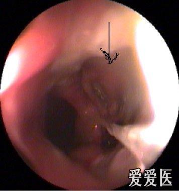 1例肛管直肠巨大窦道病人-讨论诊治方案!