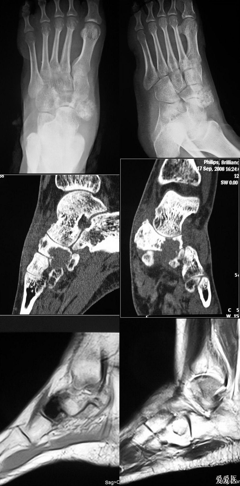 足舟骨病变,很好的病例,有病理结果,结果使您意想不到