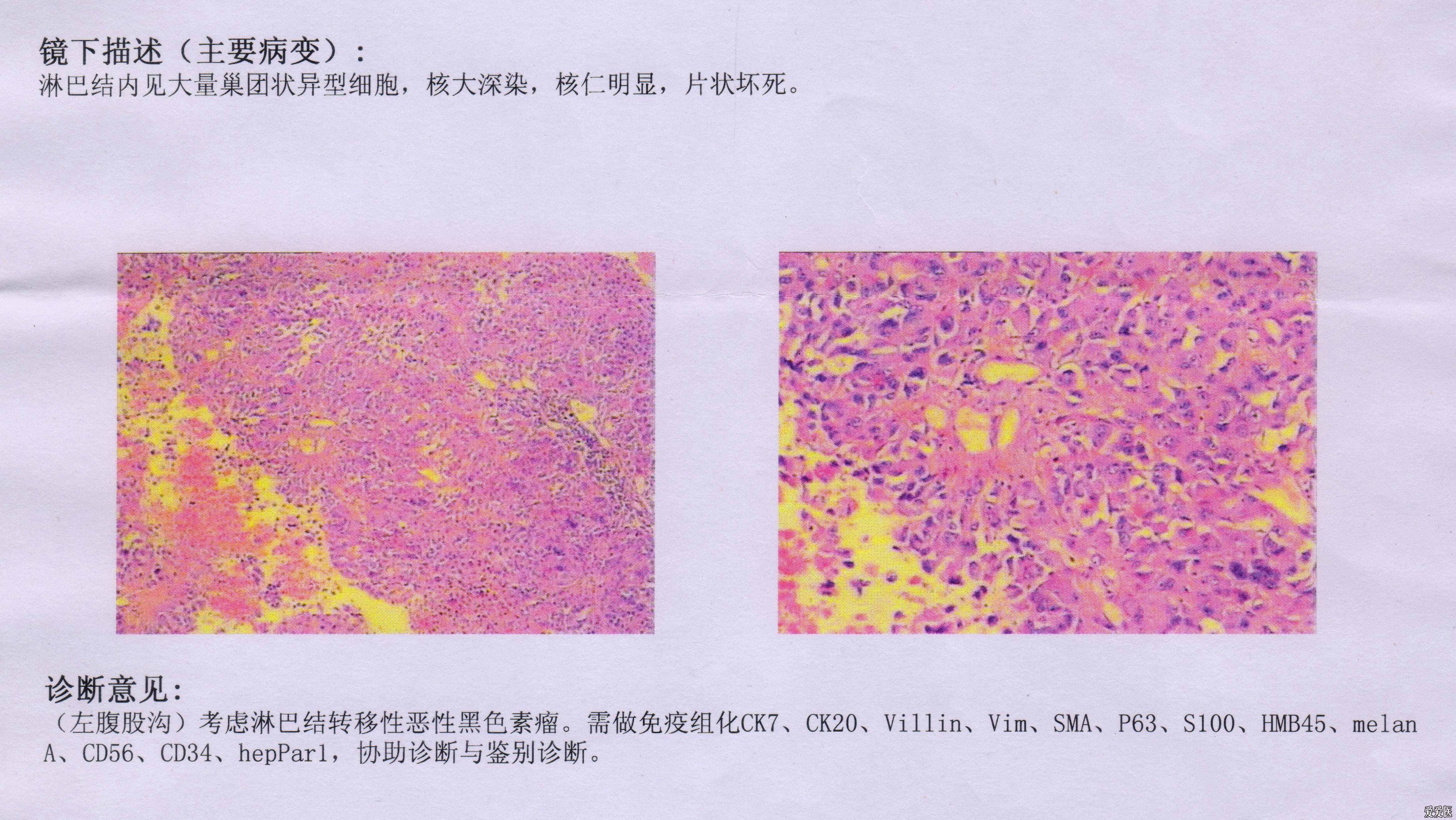 左侧腹股沟淋巴结转移性恶性黑色素瘤