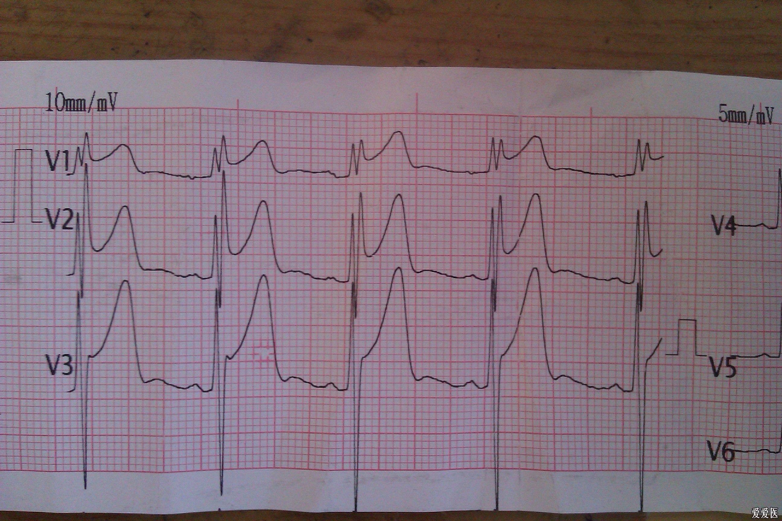 请教st 抬高的一份心电图