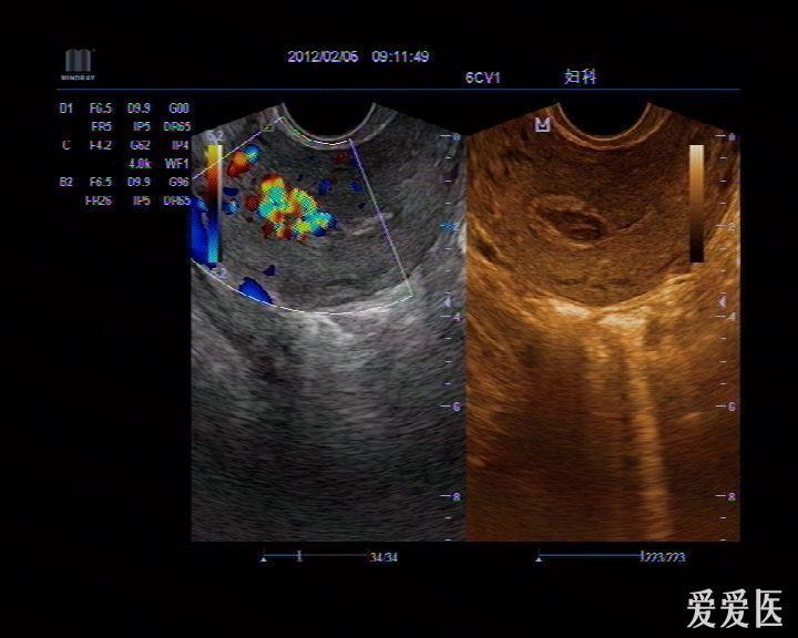 请看这图是残留物还是子宫动静脉瘘 - 超声医学讨论版
