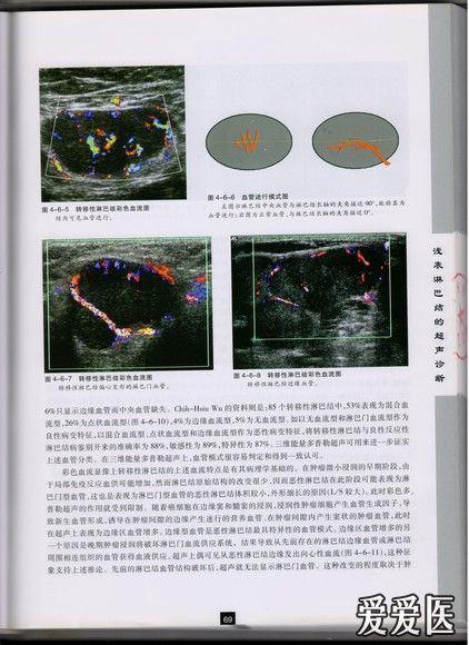 左侧腹股沟淋巴结转移性恶性黑色素瘤 - 超声医学讨论