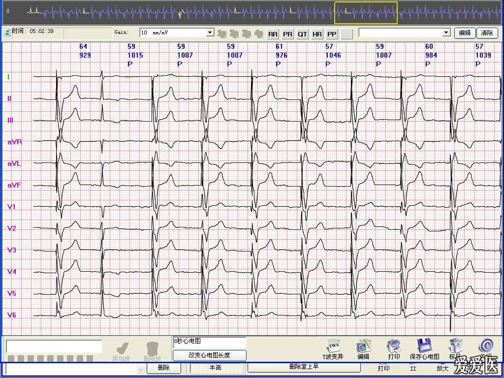 请高手看看这份起搏器心电图,急!