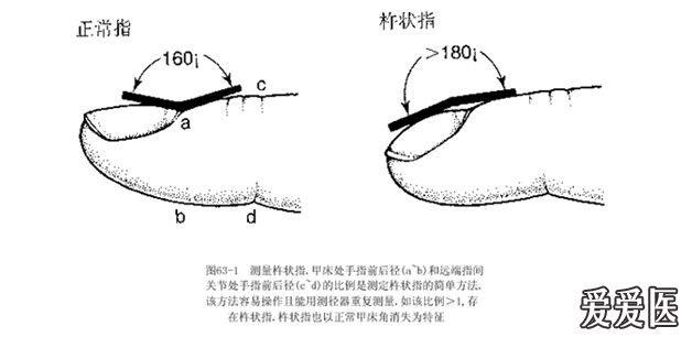 【看图识病】(1)杵状指