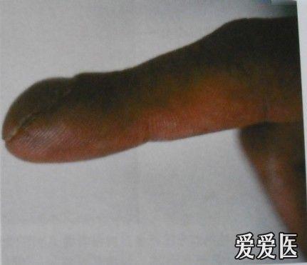 【看图识病】(1)杵状指