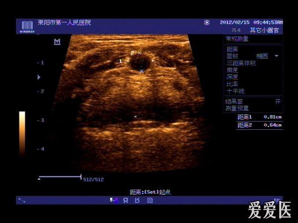 甲状舌骨囊肿 - 超声医学讨论版 - 爱爱医医学论坛 - 爱爱医医学网